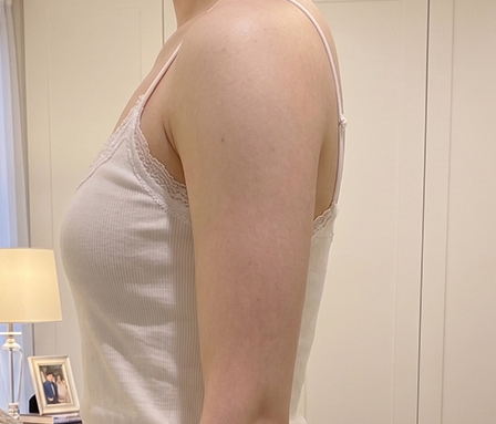 바디 팔뚝 หลังทำ