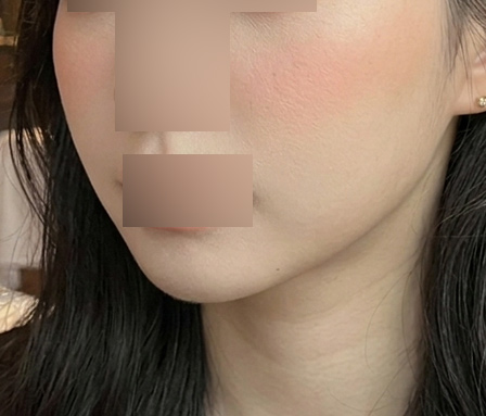 윤곽주사 이중턱 หลังทำ