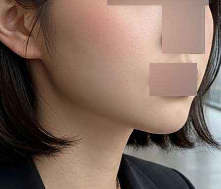 ฉีดแฟตสลายไขมันเหนียง & กระพุ้งแก้ม หลังทำ