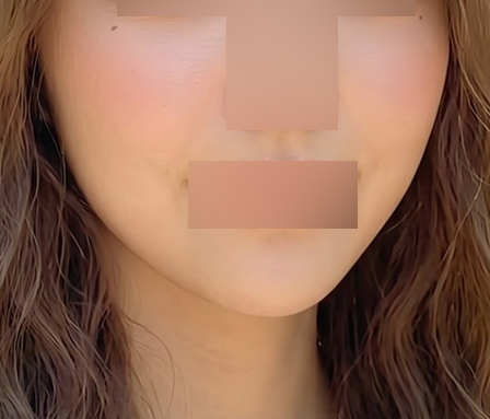 윤곽주사 이중턱 심부볼 หลังทำ