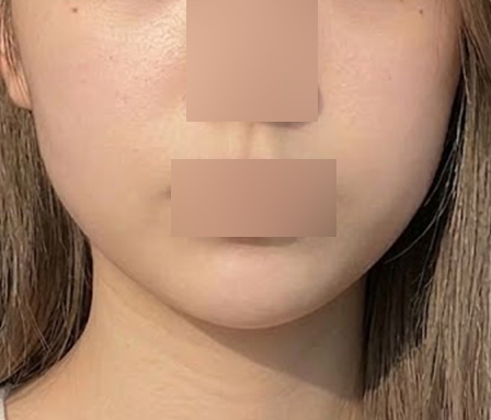 윤곽주사 이중턱 심부볼 ก่อนทำ