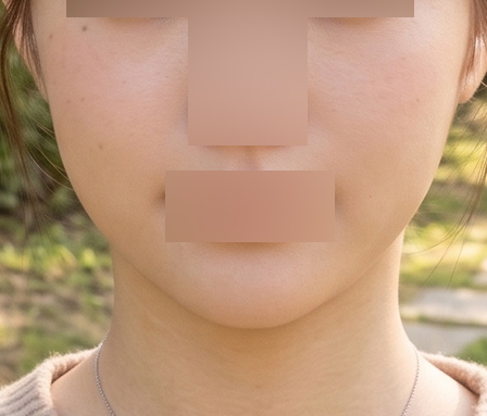 윤곽주사 얼굴전체 หลังทำ