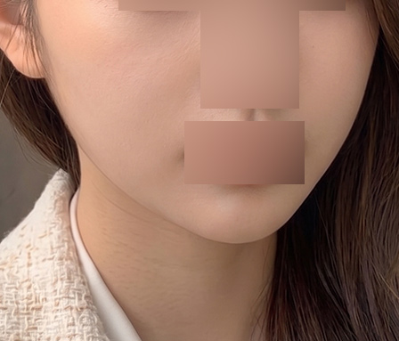턱라인 심부볼 หลังทำ