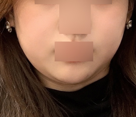 턱라인 심부볼 ก่อนทำ