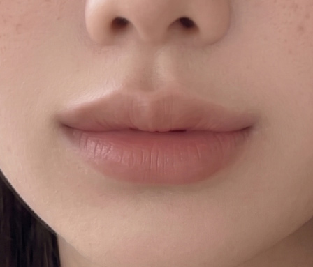 ผ่าตัดลดพื้นที่ใต้จมูก หลังทำ