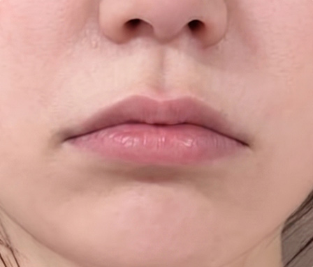 ผ่าตัดลดพื้นที่ใต้จมูก ก่อนทำ