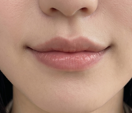 입꼬리 หลังทำ