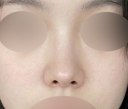 코재수술 หลังทำ