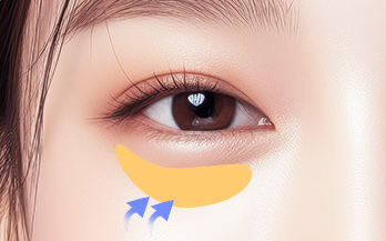 절개 및 지방재배치